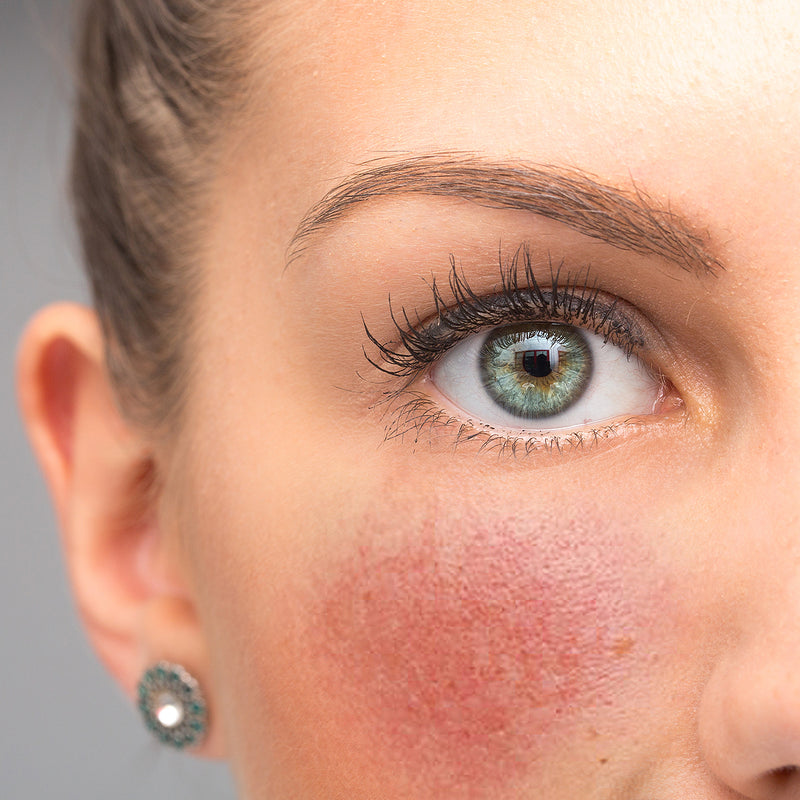 Gel anti-rougeurs BioAcne pour l'acné rosacée